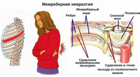 Основные причины возникновения межреберной невропатии