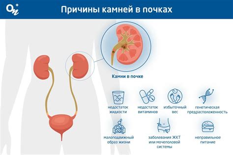 Основные симптомы наличия камней в почках