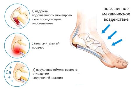 Основные симптомы пяточной шпоры