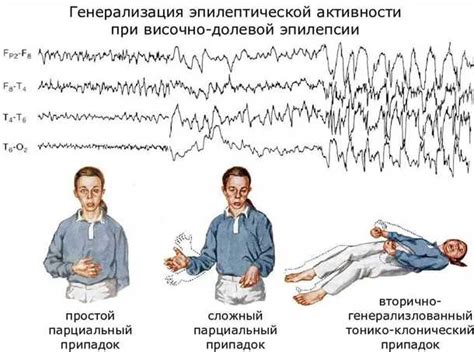 Основные симптомы эпилепсии