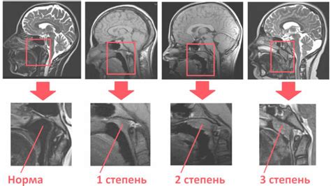 Особенности аденоидов: почему они требуют особого подхода