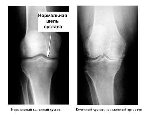 Остеоартроз и боль в колене