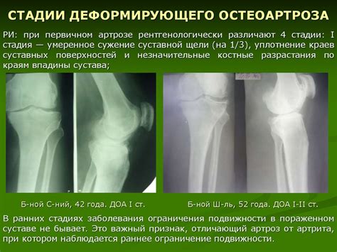 Остеоартроз сустава кисти: симптомы и диагностика