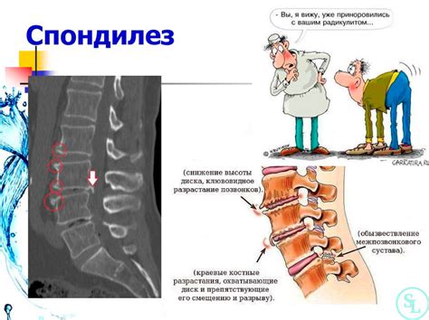 Остеохондроз и спондилез: распространенные причины