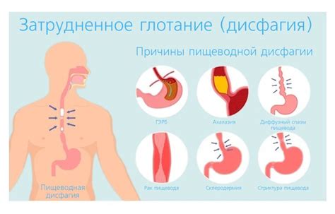 Острая пищеводная дисфагия