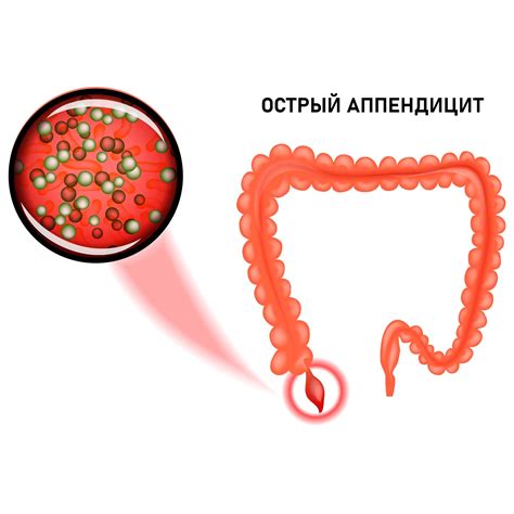 Острый аппендицит: признаки и оперативное вмешательство