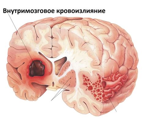 Отек и кровоизлияние