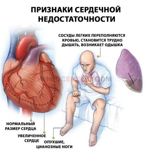 Отличия отеков, вызванных сердечной недостаточностью