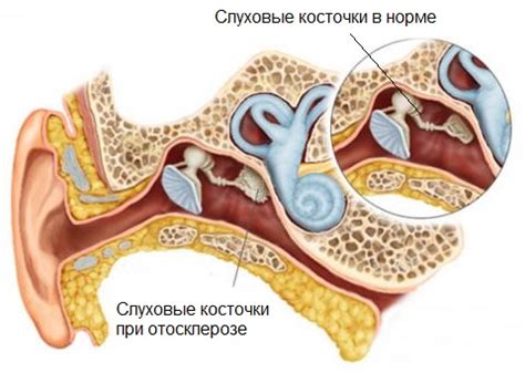 Отосклероз