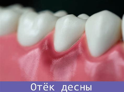 Охлаждение десен для снятия отека