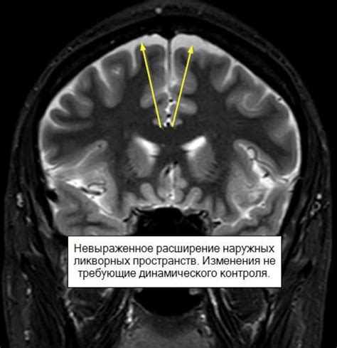 Очагово дистрофические изменения головного мозга