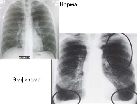 Патологии легких