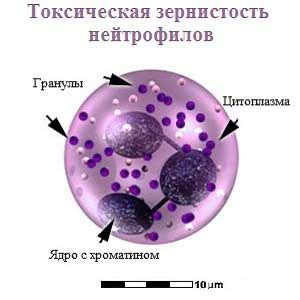 Патологические проявления токсигенной зернистости нейтрофилов