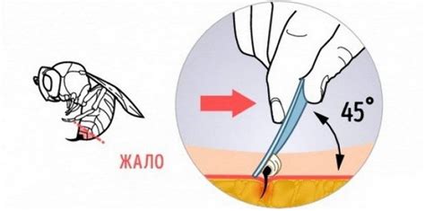 Первая помощь: удаление жала и обработка места укуса