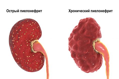 Пиелонефрит