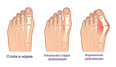 Плоскостопие может вызывать дискомфорт и боль в пальце на левой ноге