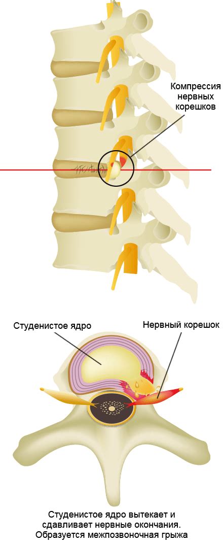 Повреждение межпозвоночных дисков: основные факторы