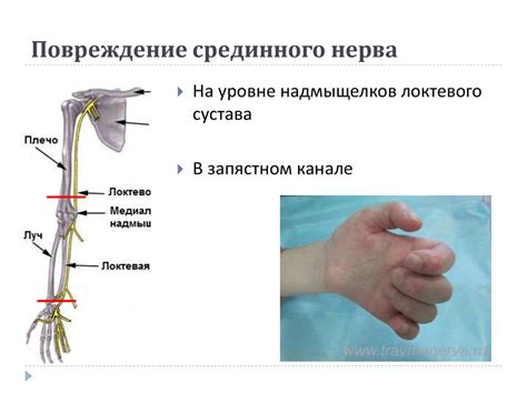 Повреждение срединного нерва: причина онемения указательного пальца