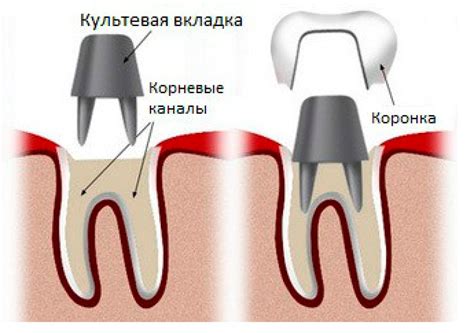 Подготовка к приклеиванию коронки зуба: