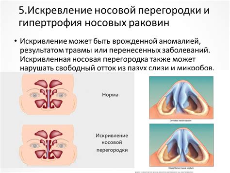 Полипы и гипертрофия носовых полостей