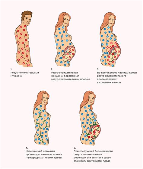 Положительный резус и беременность