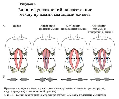 Понятие диастаза брюшных мышц