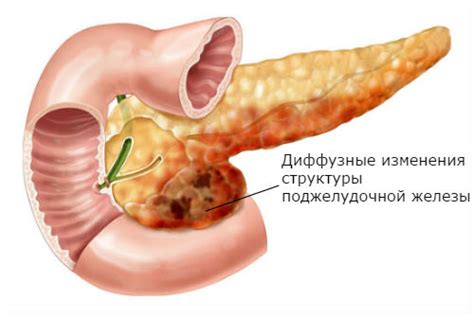 Понятие диффузных изменений