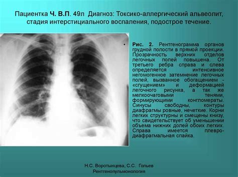 Понятие легочного рисунка в медицине