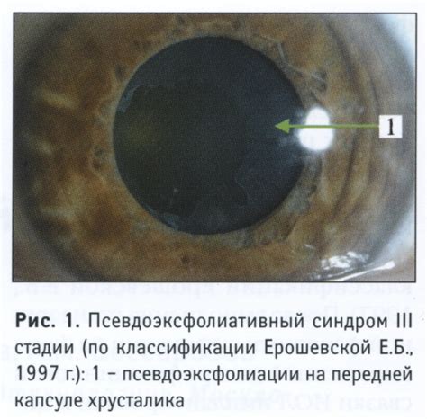 Понятие псевдоэксфолиативного синдрома глаз