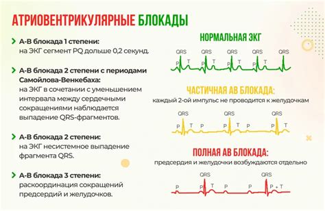 Последствия неполной блокады на ЭКГ