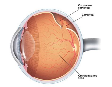 Последствия отслойки сетчатки