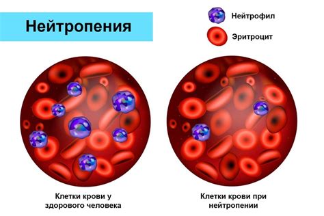 Последствия пониженного уровня нейтрофилов