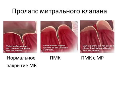 Последствия пролапса митрального клапана у детей и подростков