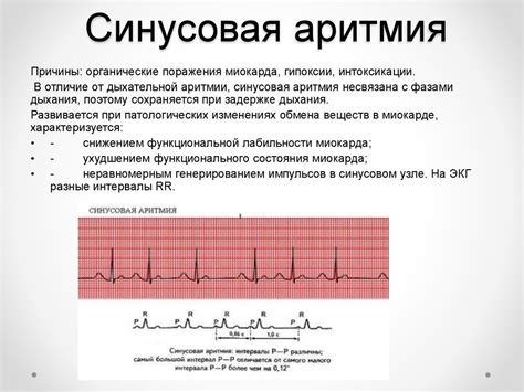 Последствия синусового нерегулярного ритма с ЧСС