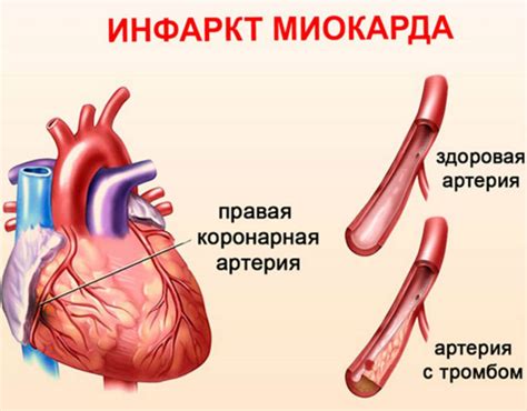 Последствия снижения кровоснабжения миокарда