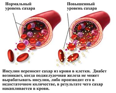 Почему возникает недостаток сахара в крови