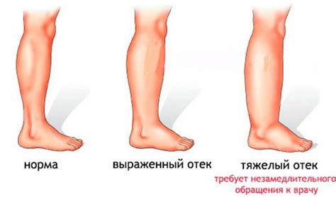 Почему возникают отеки ног и как их избежать