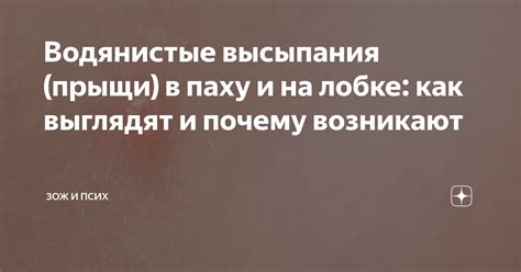 Почему возникают прыщи на лобке