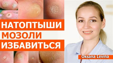 Почему мозоли образуются и как их лечить?