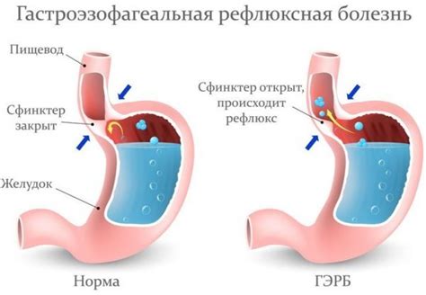 Почему не стоит делать физические нагрузки?