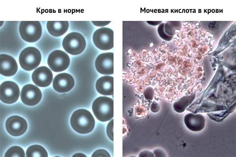 Почему повышен уровень мочевой кислоты 420 у женщины: причины и симптомы