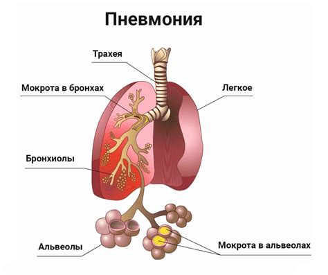 Почему при пневмонии возникает слабость?