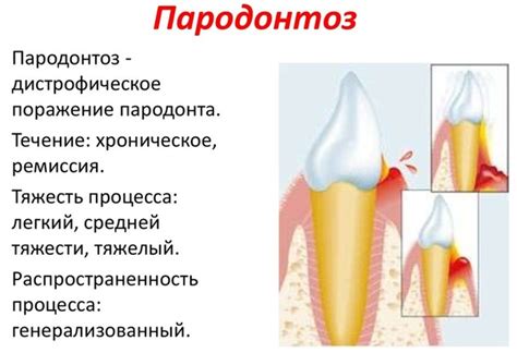 Появление пародонтоза