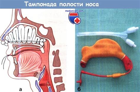 Практические советы по остановке кровотечения: