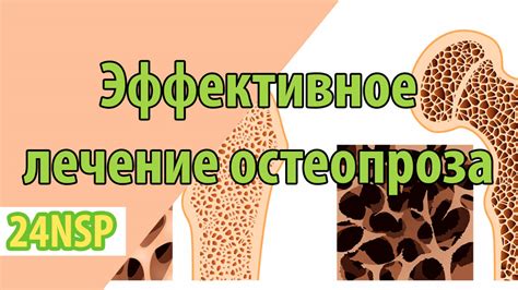 Предотвращение остеопороза с помощью кальция