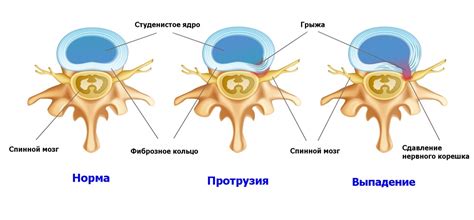 Предупреждение грыжи