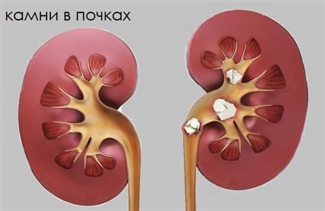 Предупреждение образования камней в почках