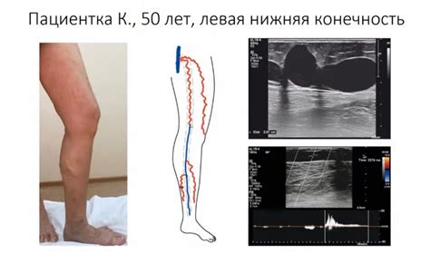 Преимущества дуплексного сканирования нижних конечностей