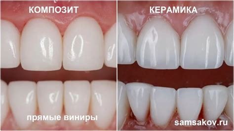 Преимущества использования виниров