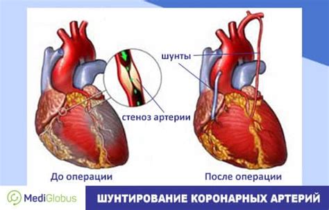 Преимущества и особенности минимально инвазивного аортокоронарного шунтирования